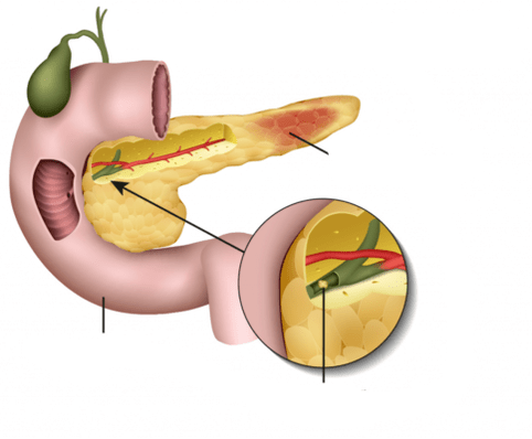 pankreatit pankreas iltihabıdır